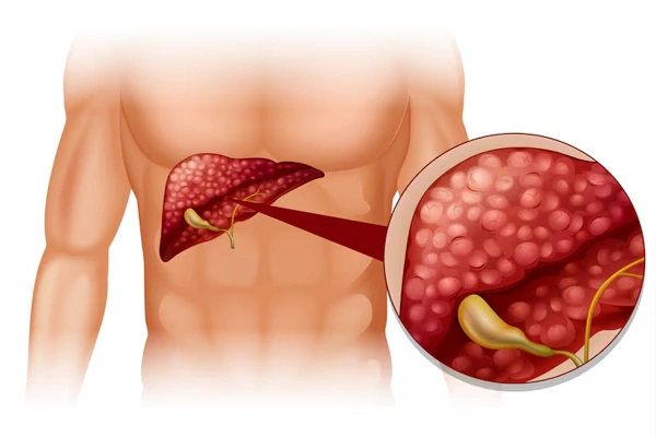 Fatty Liver