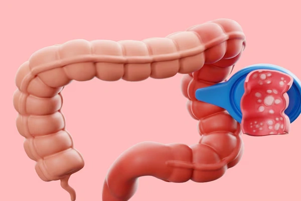 Colitis