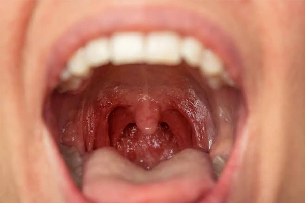 Tonsillitis