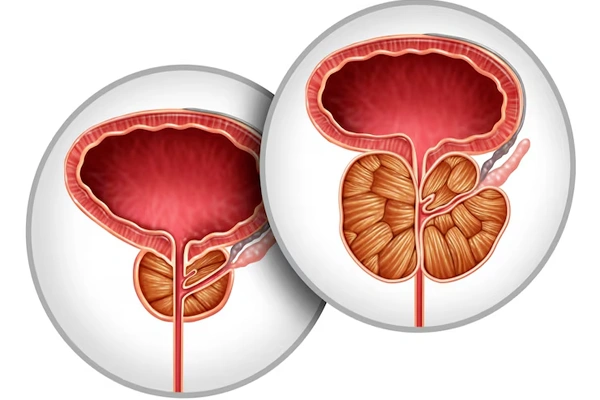 Prostate Enlargement