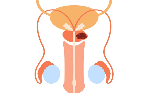 Prostate Discharge