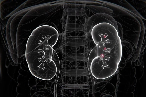 Renal Stone