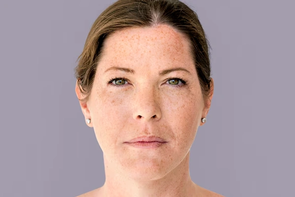 Melasma